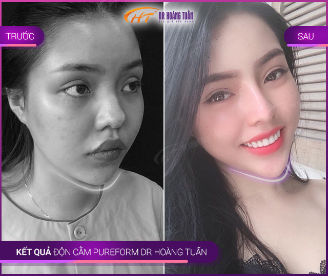 Kết quả độn cằm Pureform Thẩm mỹ Hoàng Tuấn